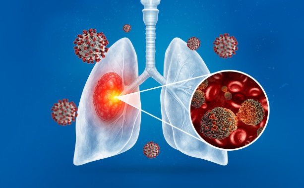 Programe naționale de screening pentru cancerul pulmonar cerute de FABC