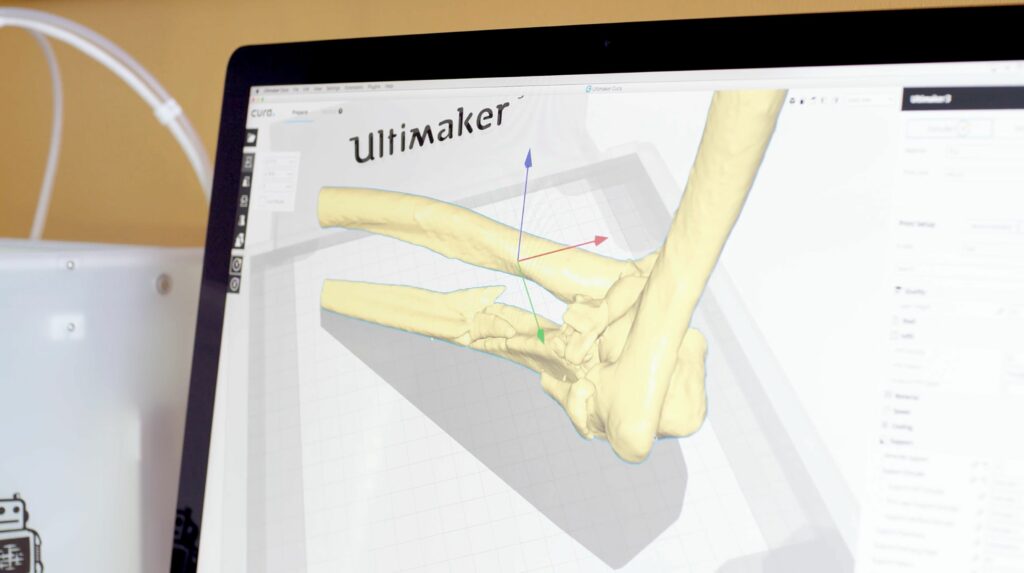 Tratament revoluționar pentru fracturi: „adezivul osos” repară oasele rupte cu o singură injecție, prin lipirea fragmentelor