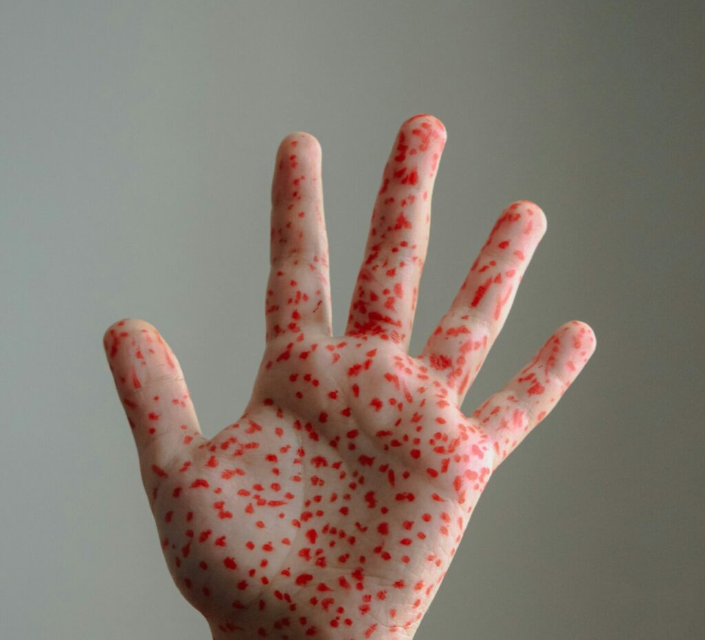 Canada își pierde statutul de țară fără rujeolă, după trei decenii