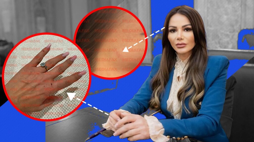 Primele imagini cu urmările agresiunii asupra senatoarei POT. Valentina Aldea are nevoie de 2-3 zile de îngrijiri medicale după ce a fost atacată cu o bară din metal | GALERIE FOTO