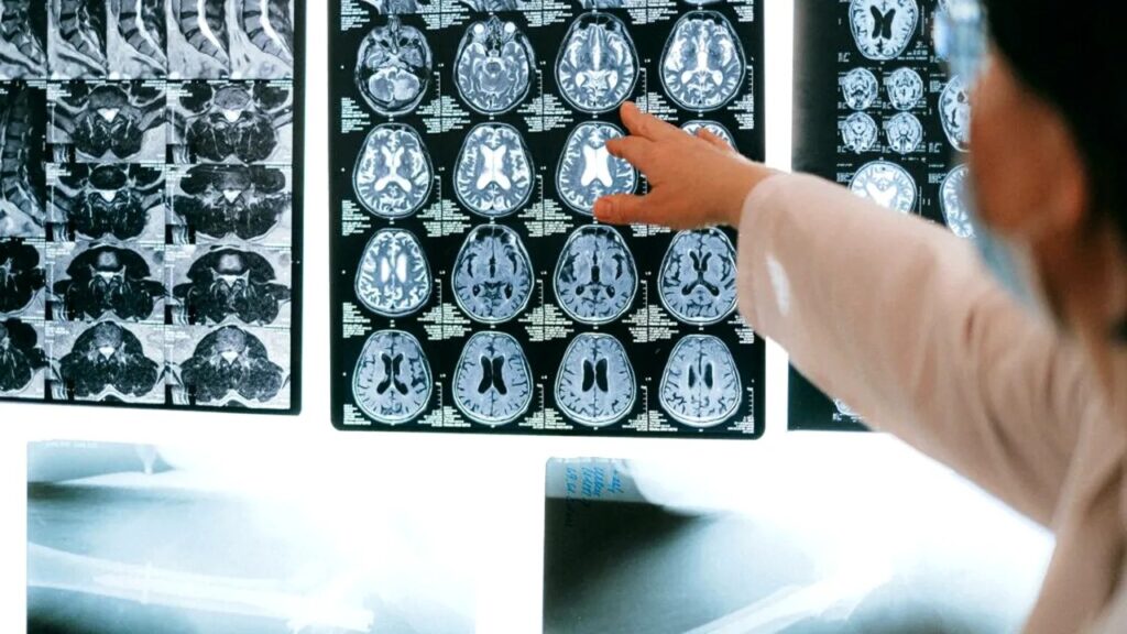 Record îngrijorător: Cel mai tânăr pacient cu Alzheimer din lume