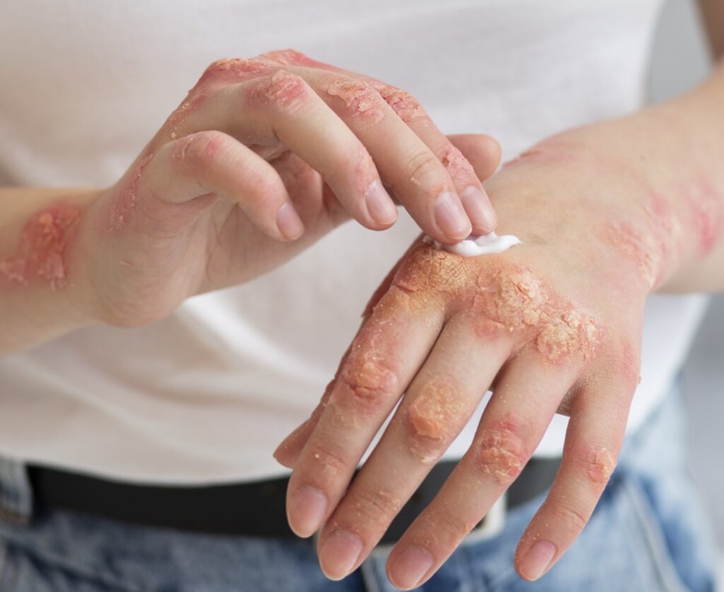 Pielea pierde apă iarna: Sfaturile medicilor pentru protecție