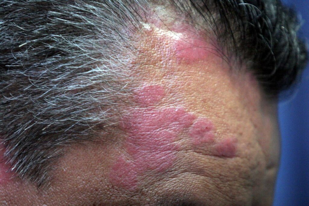 Speranță pentru cei care suferă de psoriazis: o nouă tehnică fotonică reușește să îl trateze fără efecte secundare