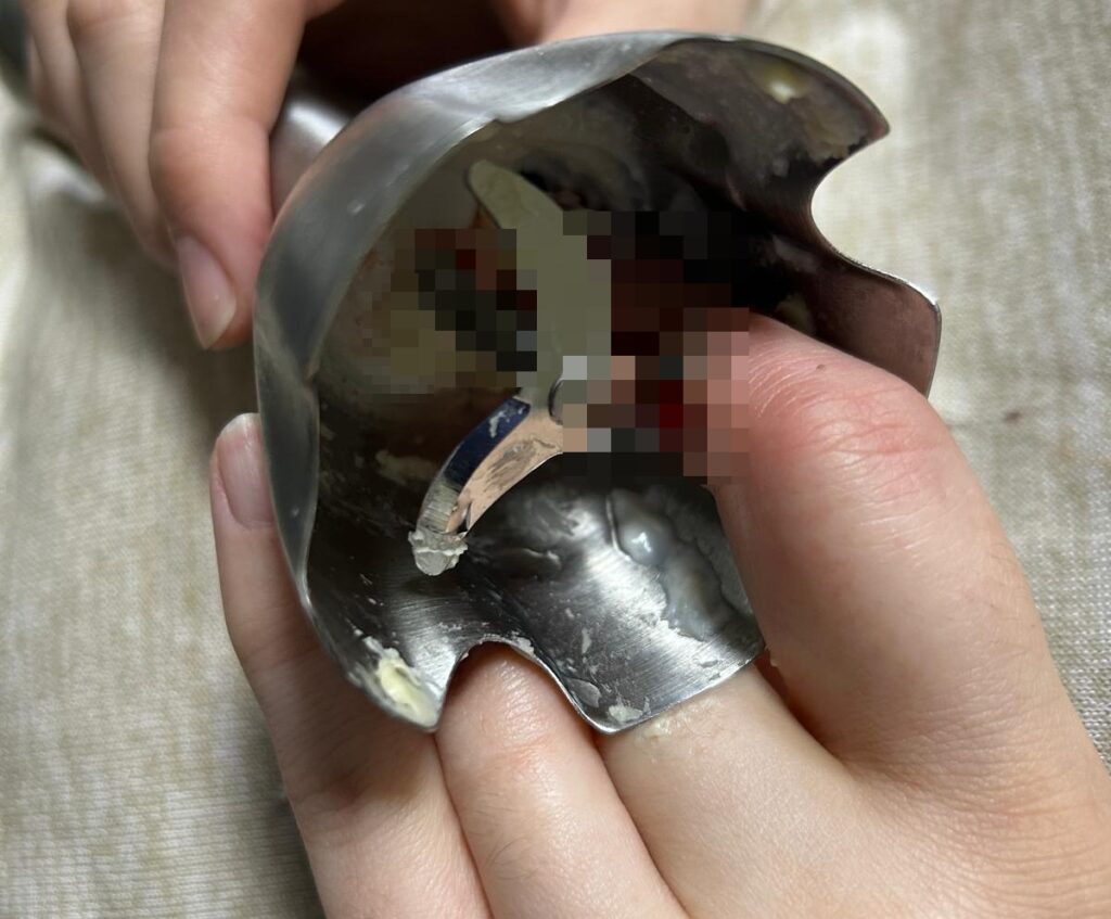 Două femei din Iași au ajuns la spital în urma unor accidente casnice grave