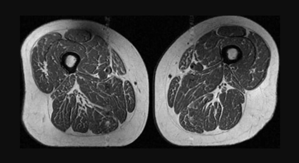 Alimentele ultraprocesate „transformă” mușchii în grăsime: semnal de alarmă dintr-un nou studiu
