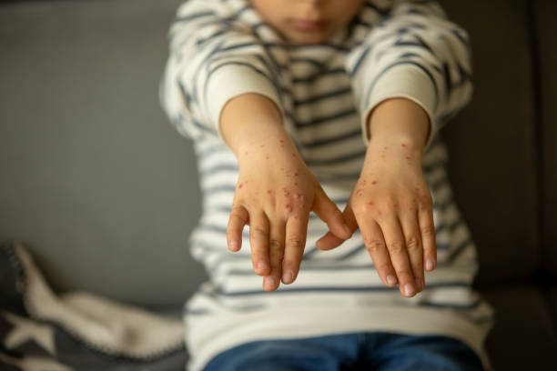 Measles: Permanent Immune, Brain Damage
