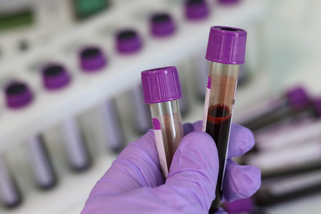 Un test de sânge ar putea prezice dacă adulții sănătoși sunt predispuși la Alzheimer