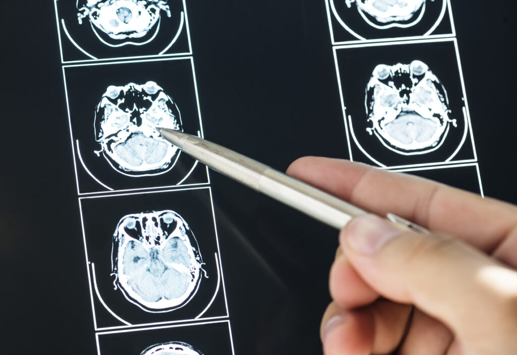 M-am întors din India cu 38 de paraziți în creier. Cum s-a infectat o femeie de 42 de ani fără să mănânce carne