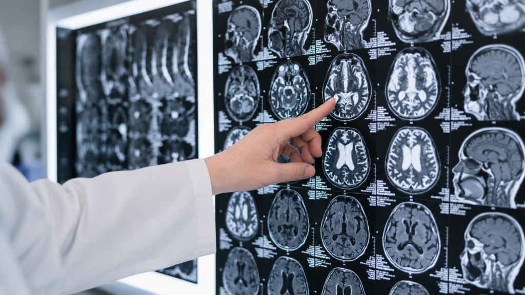 Semnele unui accident vascular cerebral. Medicii explică în ce situații trebuie să suni la 112