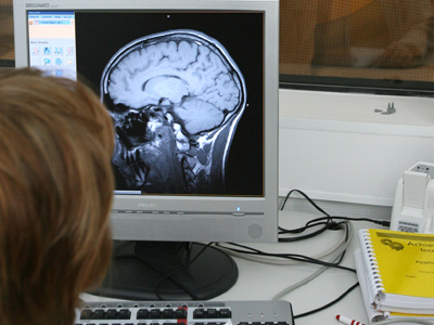 NRTI, medicamentele anti-HIV care ar putea preveni un milion de cazuri de Alzheimer anual